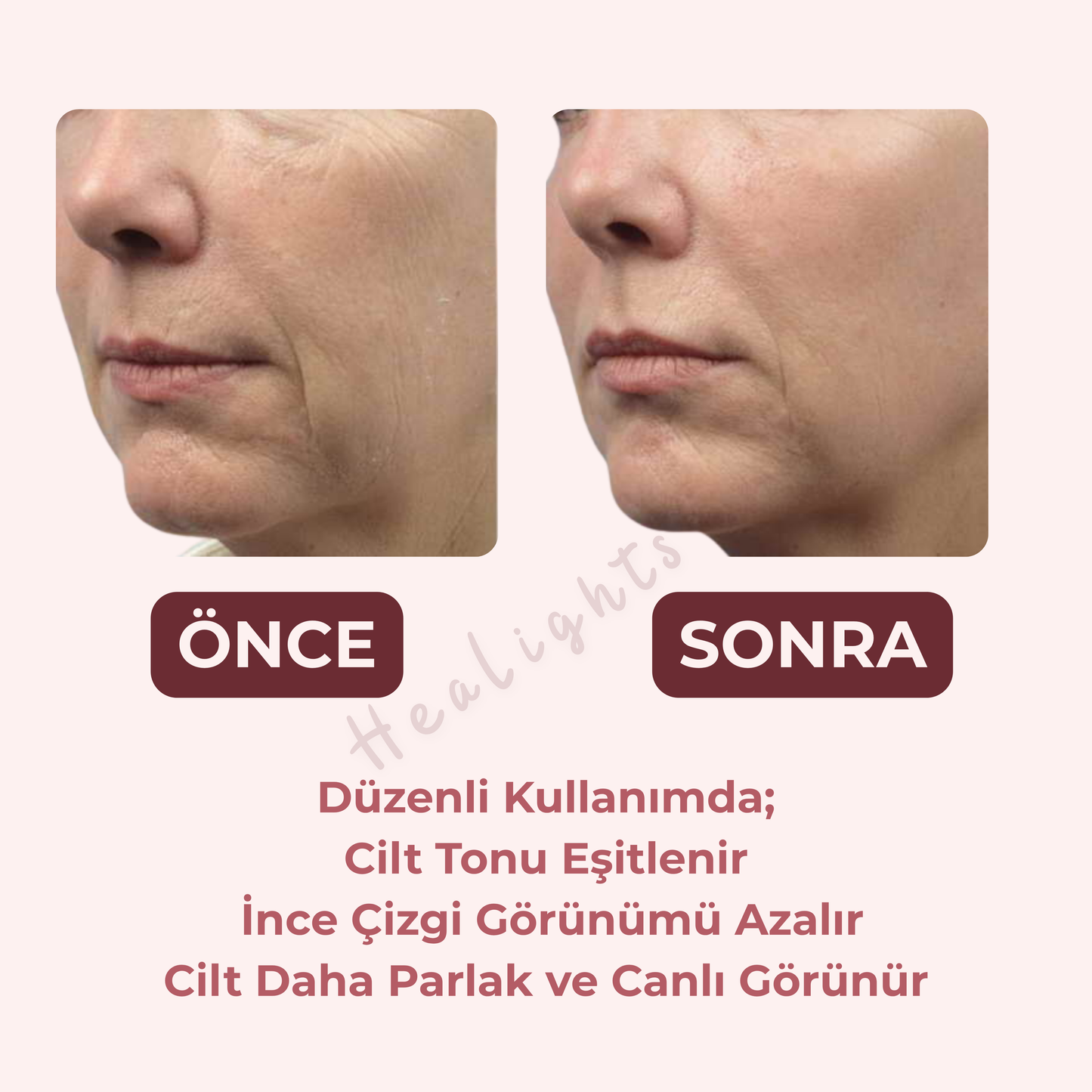 Healights Kırmızı Işık Terapisi